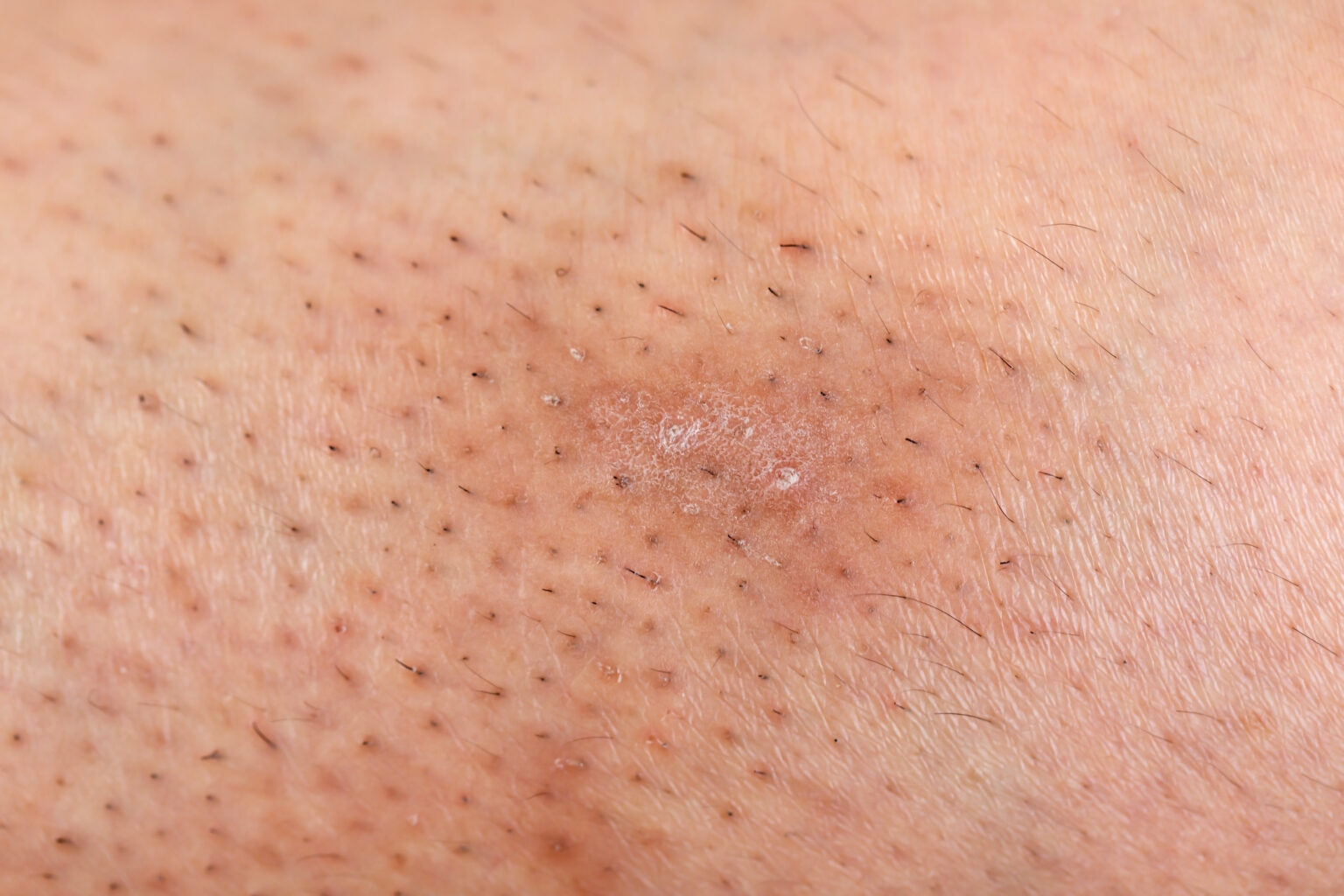 Ingegroeide haar verkomen door laserontharing bij MOYS huidkliniek