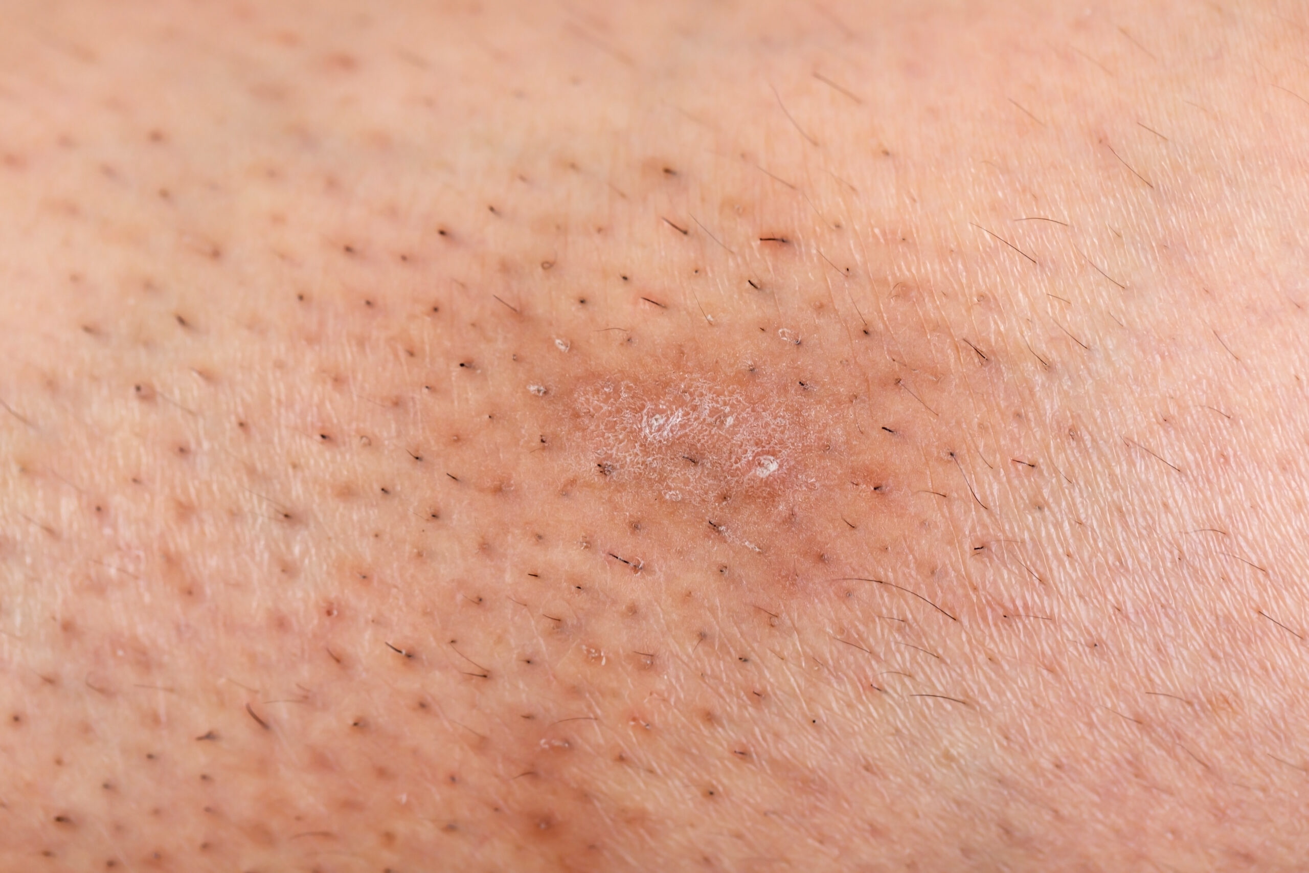 Ingegroeide haar verkomen door laserontharing bij MOYS huidkliniek
