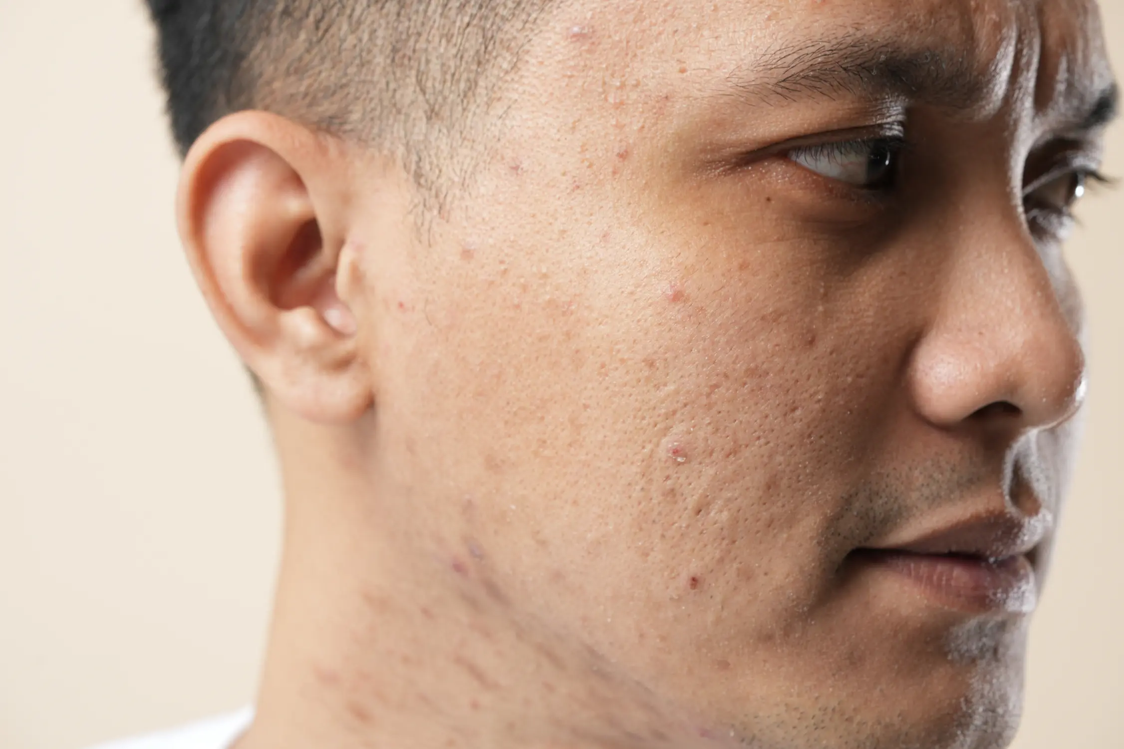 Man met acne & acne-littekens​ MOYS huidkliniek