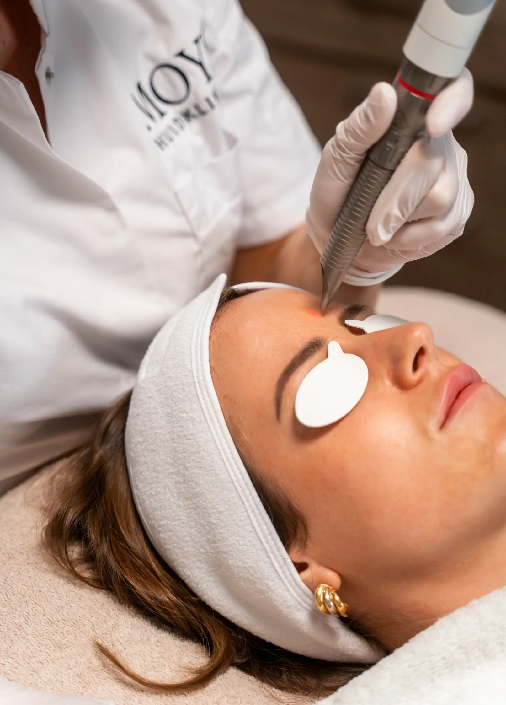 Fotona 4D behandeling van het voorhoofd bij Huidkliniek Moys in Malden voor huidverjonging en collageenstimulatie