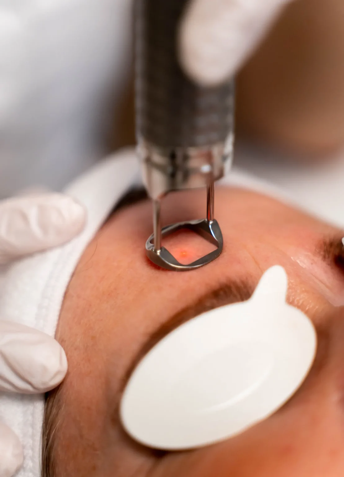 Fractional laserbehandeling van het voorhoofd bij Huidkliniek Moys in Malden uitgevoerd door huidtherapeut