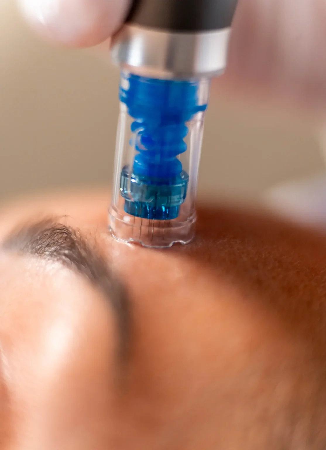 Microneedling met SkinPen bij Huidkliniek Moys in Malden voor huidverbetering