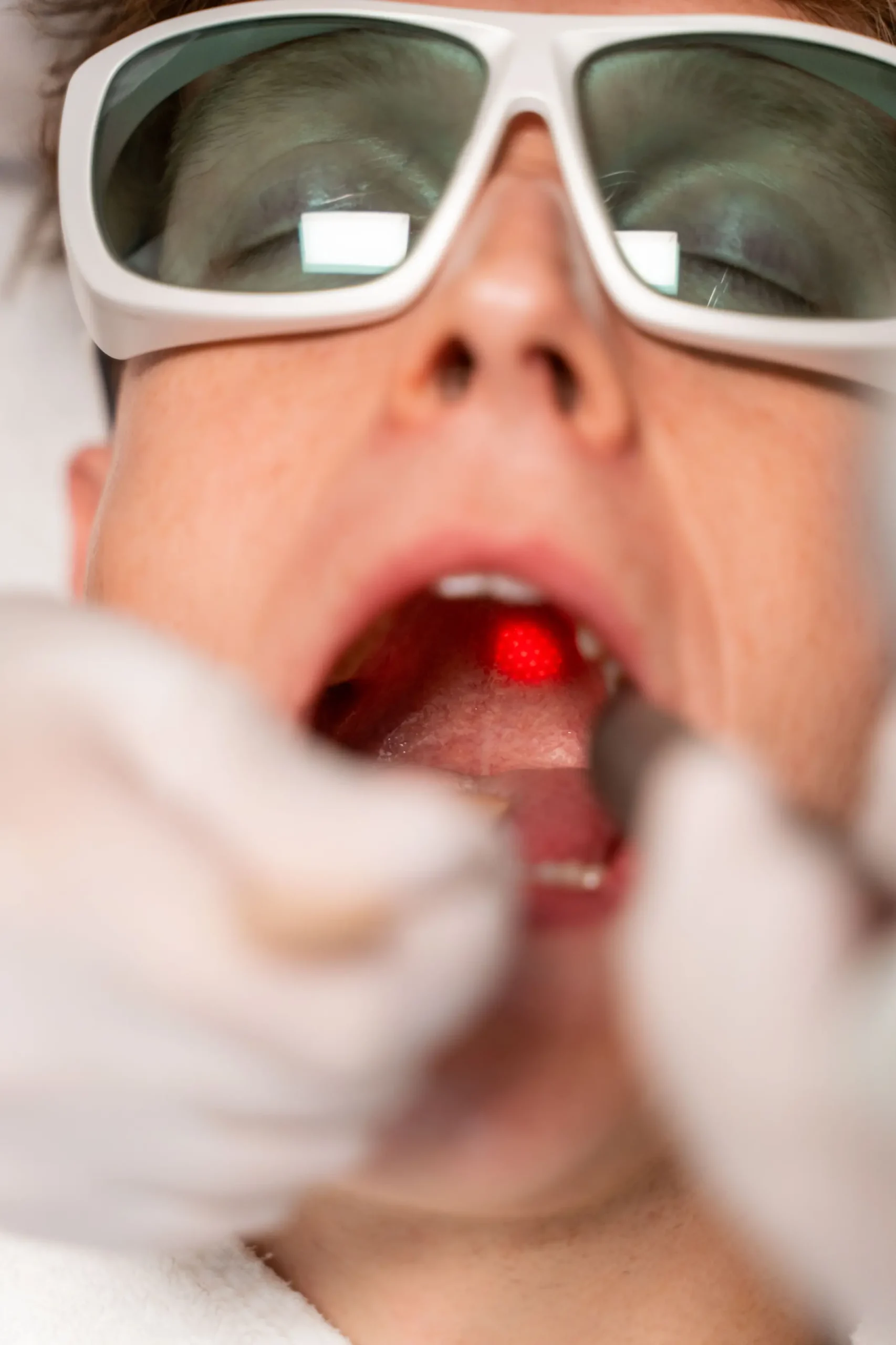 Fotona 4D laserbehandeling via de mond bij Huidkliniek Moys in Malden voor verstrakking van de huid van binnenuit