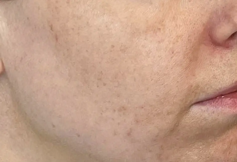 Na Fractional Laser 4 – 1