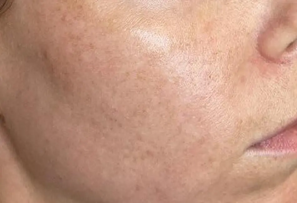 Voor Fractional Laser 4 – 1