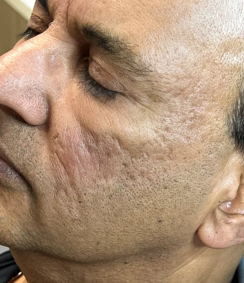 Voor acne littekens 1